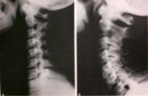 Neck X Rays